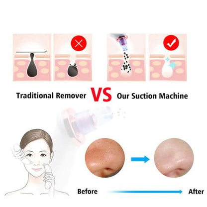 Blackhead Removal Suction Tool